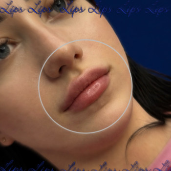 Збільшення губ: Від 3500грн