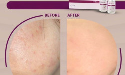 ✨ PRX-T33 — інноваційний біоревіталізуючий пілінг Косметолог-эстетист Катерина Николаев