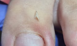 Обробка врослого нігтя Подолог Ольга Одеса