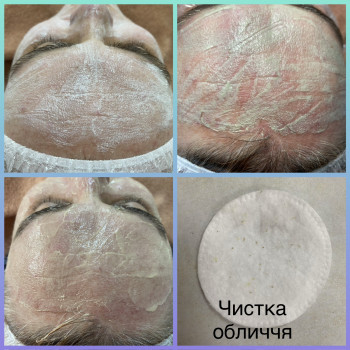 Чистка обличчя механічна