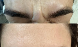 Ботулинотерапия лица Косметологічний центр Inspira Clinic Health & Beauty Хмельницький