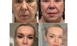 Ниткове армування Дерматолог косметолог Виктория Александровна Кривий Ріг