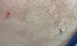 Видалення папілом, невусів, бородавок Дерматолог косметолог Виктория Александровна Кривой Рог