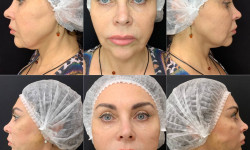 Нитковий ліфтинг Дерматолог косметолог Виктория Александровна Кривий Ріг