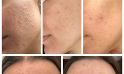 Лікування акне Дерматолог косметолог Виктория Александровна Кривой Рог