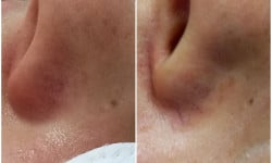 Видалення судин Дерматолог косметолог Виктория Александровна Кривой Рог