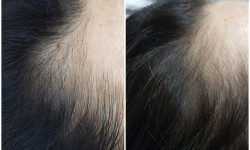 Лікування випадіння волосся Дерматолог косметолог Виктория Александровна Кривий Ріг