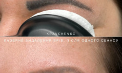 Удаление татуажа бровей лазером Врач-косметолог Филипп Киев