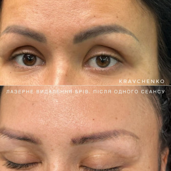 Видалення татуажу лазером. До та після одного сеансу