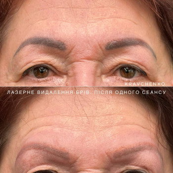 Видалення татуажу лазером. До та після одного сеансу