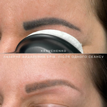 Видалення татуажу лазером. До та після одного сеансу