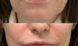 Заполнение носогубных складок Врач-косметолог Филипп Киев