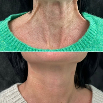 Ботокс платизми шиї | Ботокс платизмы шеи