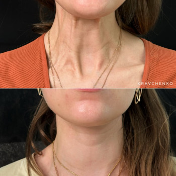 Ботокс платизми шиї | Ботокс платизмы шеи