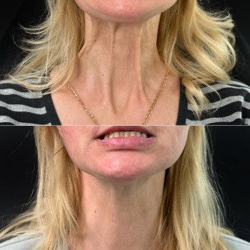 Ботокс платизми шиї | Ботокс платизмы шеи