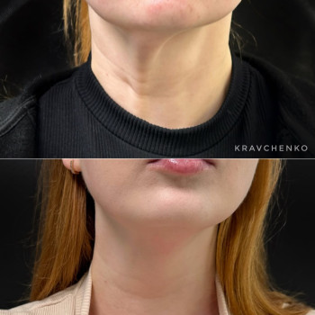 Ботокс платизми шиї | Ботокс платизмы шеи