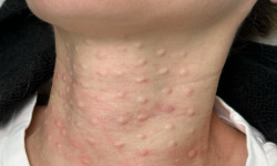 Биоревитализация Врач-косметолог Филипп Киев