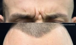 Ботокс FullFace Врач-косметолог Филипп Киев