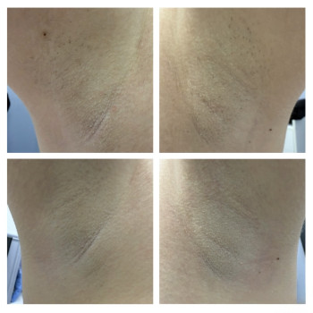 Лазерная эпиляция в действии