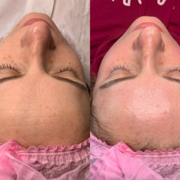 PRXT-33 Корекція домашнього догляду