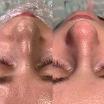 Чистка та пілінг