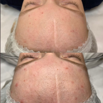 Чистка та пілінг