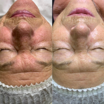 Карбоксітерапія