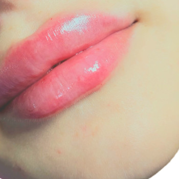 Збільшення губ філлером 3500грн