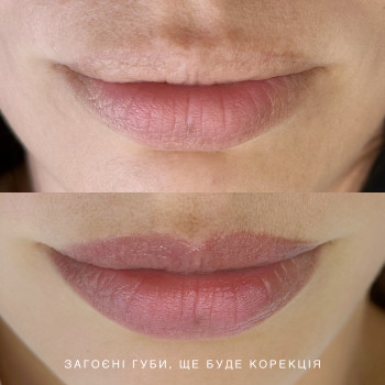 Загоєні губи