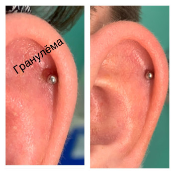 Лечение гранулёмы