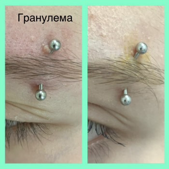 Лечение гранулёмы
