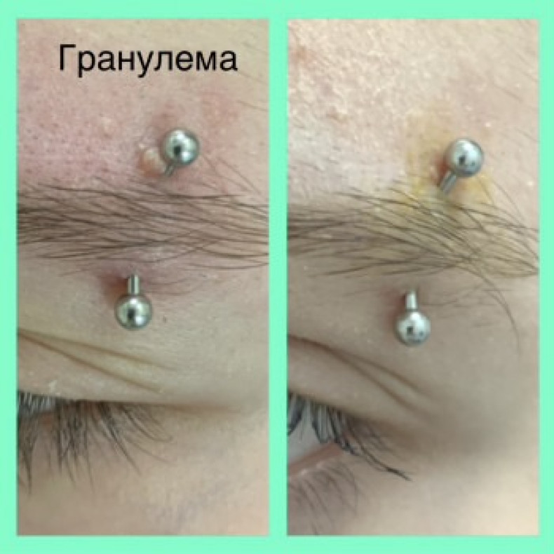 Лечение гранулёмы, фото - Мастер по пирсингу Татьяна Ананьева