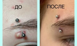 Лікування травмованих проколів Мастер по пирсингу Татьяна Киев