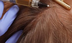 Мезотерапія шкіри голови Врач-косметолог Юлія Луцк