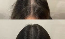 Microneedling DRS для шкіри голови Врач-косметолог Юлія Луцк