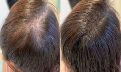 Дарсонваль для шкіри голови Врач-косметолог Юлія Луцк