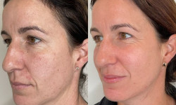 RRS Long - миттєвий ліфтинг обличчя Лікар-косметолог Юлія Луцьк