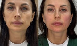 Мезотерапія амінокислотами — Омолодження та відновлення шкіри Лікар-косметолог Юлія Луцьк