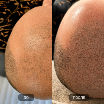 Трихопігментація (SMP) Ефект густоти волосся без операцій Натуральний результат, що виглядає як власне волосся