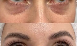 Біоревіталізація навколо очей TWAC eyes Лікар-косметолог Юлія Луцьк