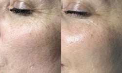 RRS Eyes — ін’єкційне відновлення зони навколо очей Лікар-косметолог Юлія Луцьк