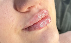 Контурна пластика губ Косметолог-ін'єкціоніст Любов Запоріжжя