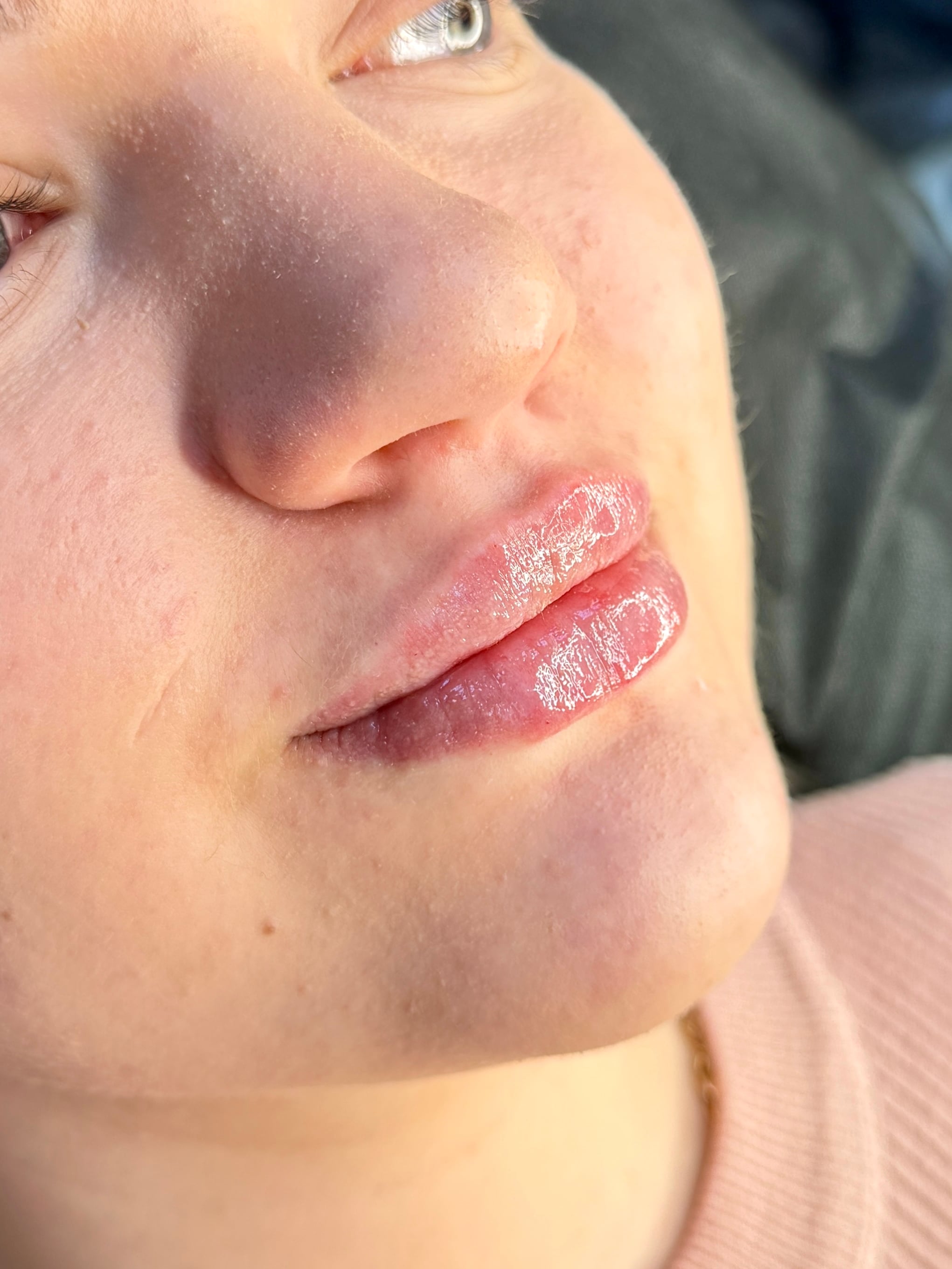 Збільшення губ контурна пластика, фото - Косметолог-ін'єкціоніст Любов Чумаченко