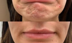 Ботокс Косметолог-инъекционист Любов Запорожье