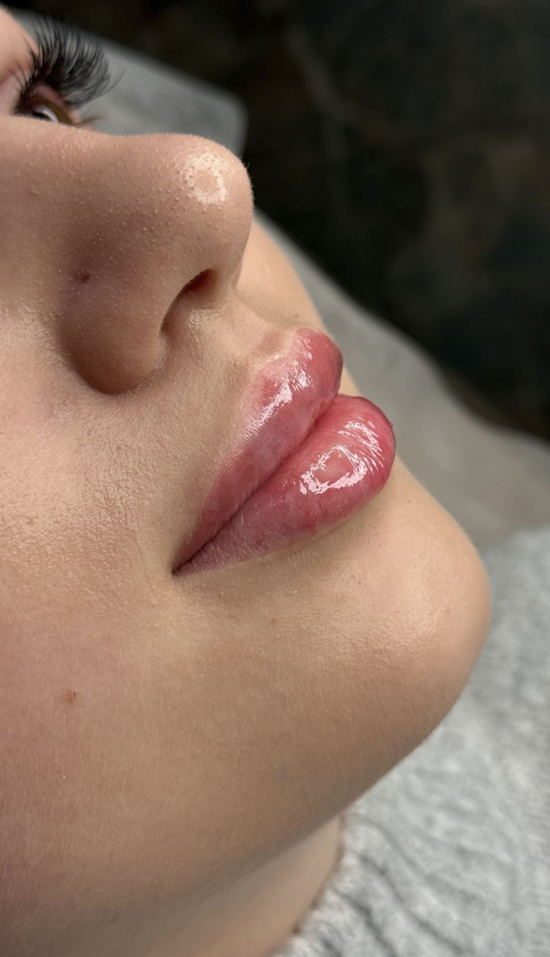 Контурна пластика губ, фото - Косметолог-ін'єкціоніст Любов Чумаченко