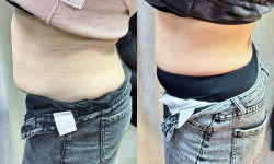 Похудение с Biop@tid Косметолог-ін'єкціоніст Любов Запоріжжя