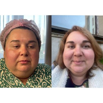 Полімолочна кислота 1 процедура.