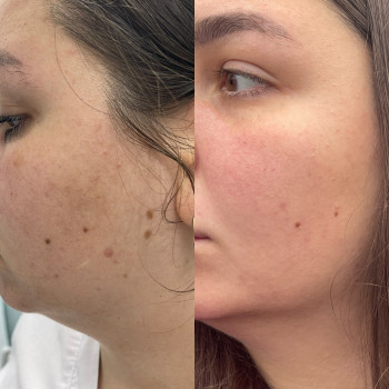 Лікування шкіри мезосистемою біорерараціі