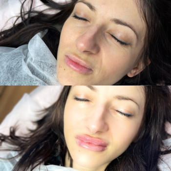 Контурна пластика губ