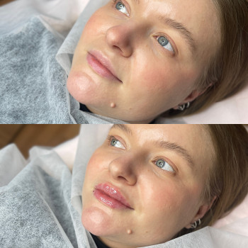 Контурна пластика губ та підборіддя